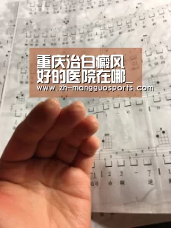 重庆治白癜风好的医院在哪_芒果体育(图2) 芒果体育